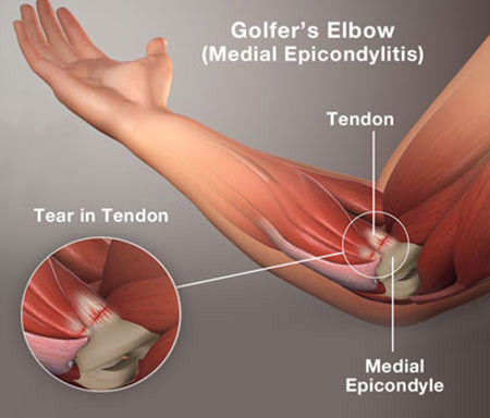 Golfers Elbow Repair