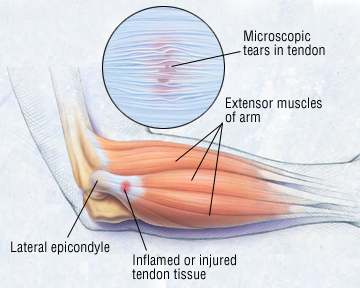 Tennis Elbow