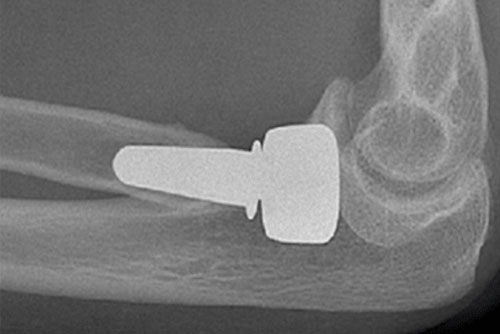 Radial Head Replacement
