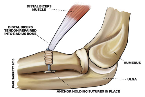 Bicep Tendon Repair Surgery