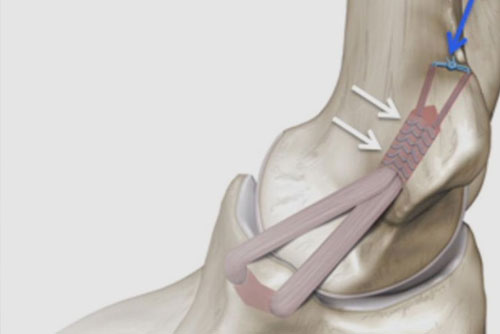 Elbow Ligament Repair